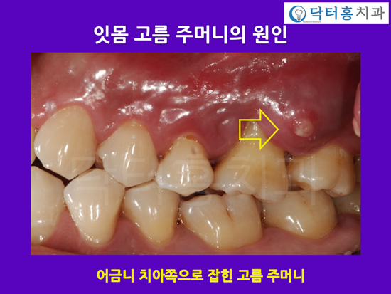 잇몸 고름주머니, 원인과 치료법 : 네이버 블로그
