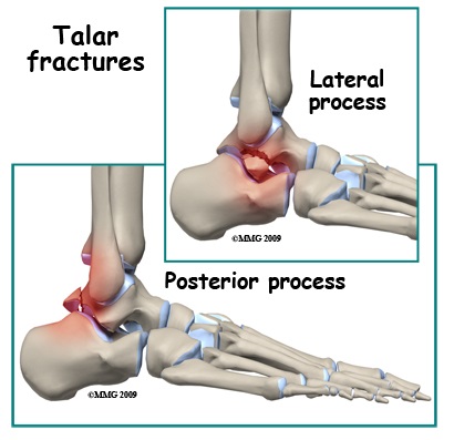 거골 골절(Talus fracture) : 높은 곳에서 떨어진 뒤 걸을 수가 없어요 : 네이버 블로그